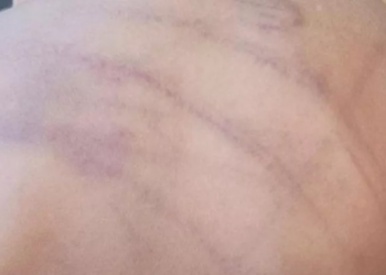 Bebê de 1 ano é internado com sinais de espancamento em Barra do Garças