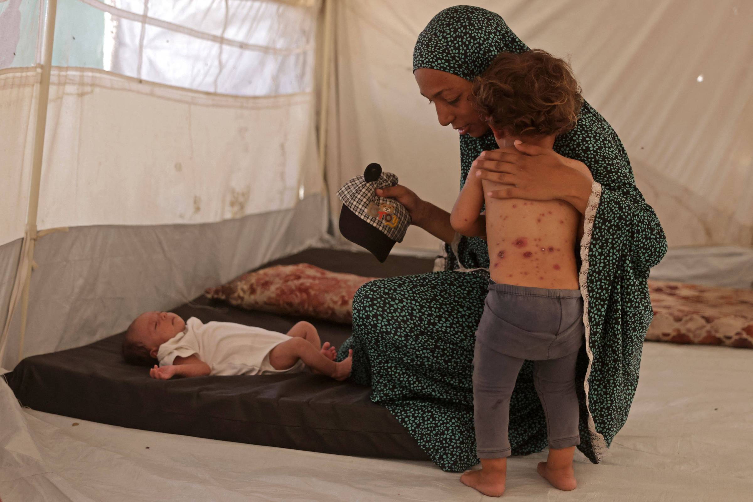Catapora se espalha pelos superlotados acampamentos de deslocados em Gaza